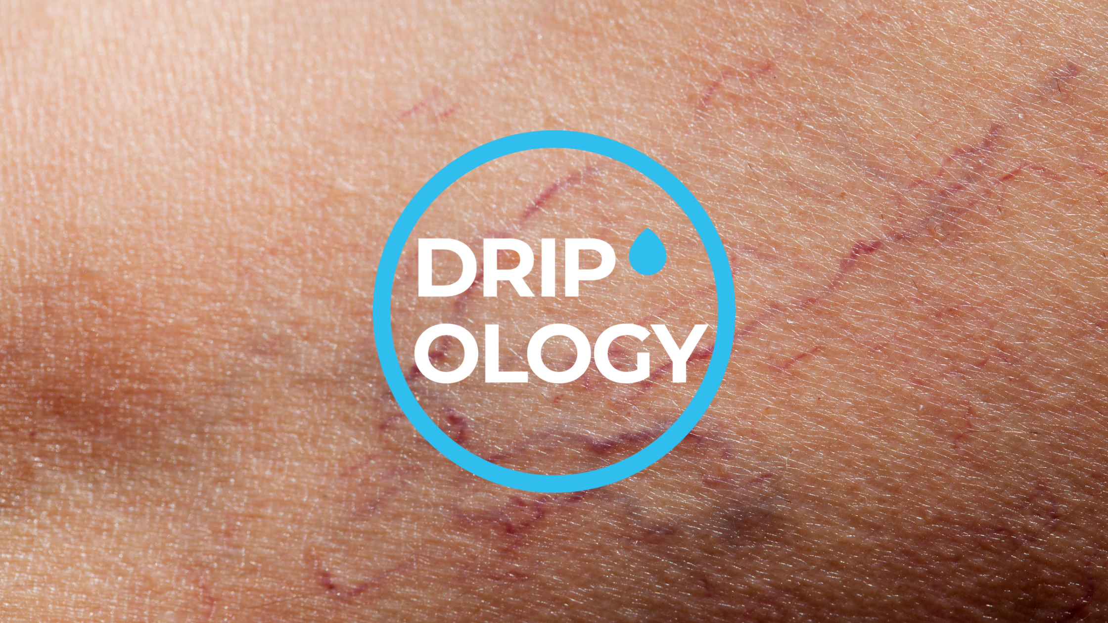 Lumecca for Veins: A Solution for Improving the Appearance of Spider Veins